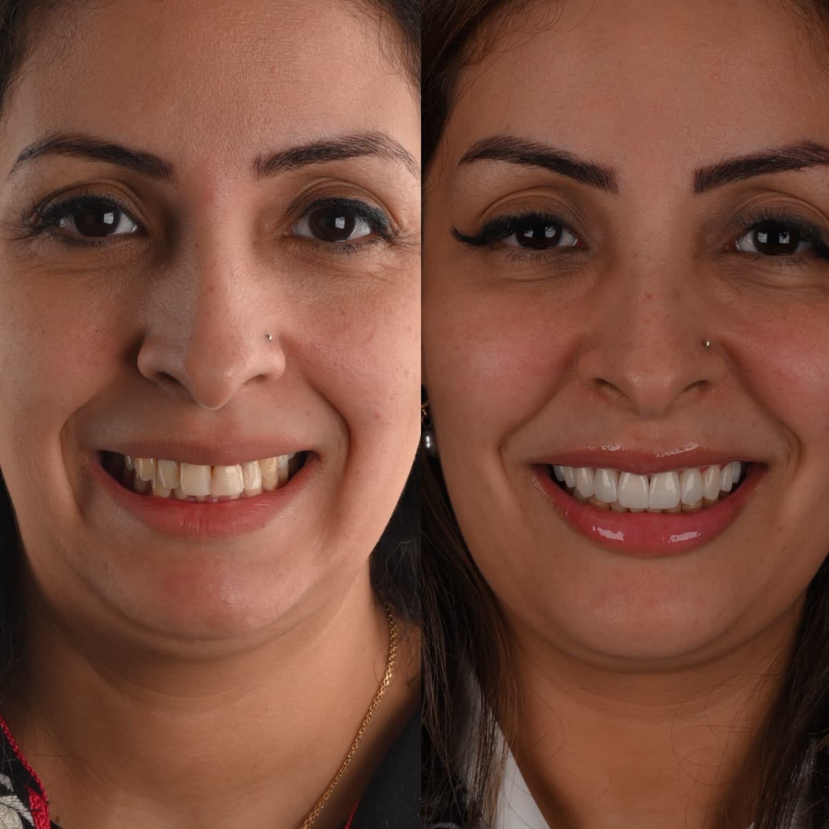 Facettes dentaires à Casablanca avant après, esthétique du sourire - Master Smile Clinic